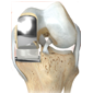 Partial-Knee-Replacement