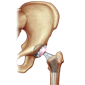 Total-Hip-Replacement